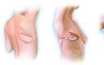 Plastična operacija po odstranitvi dojke Kje se izvaja plastična operacija po odstranitvi dojke